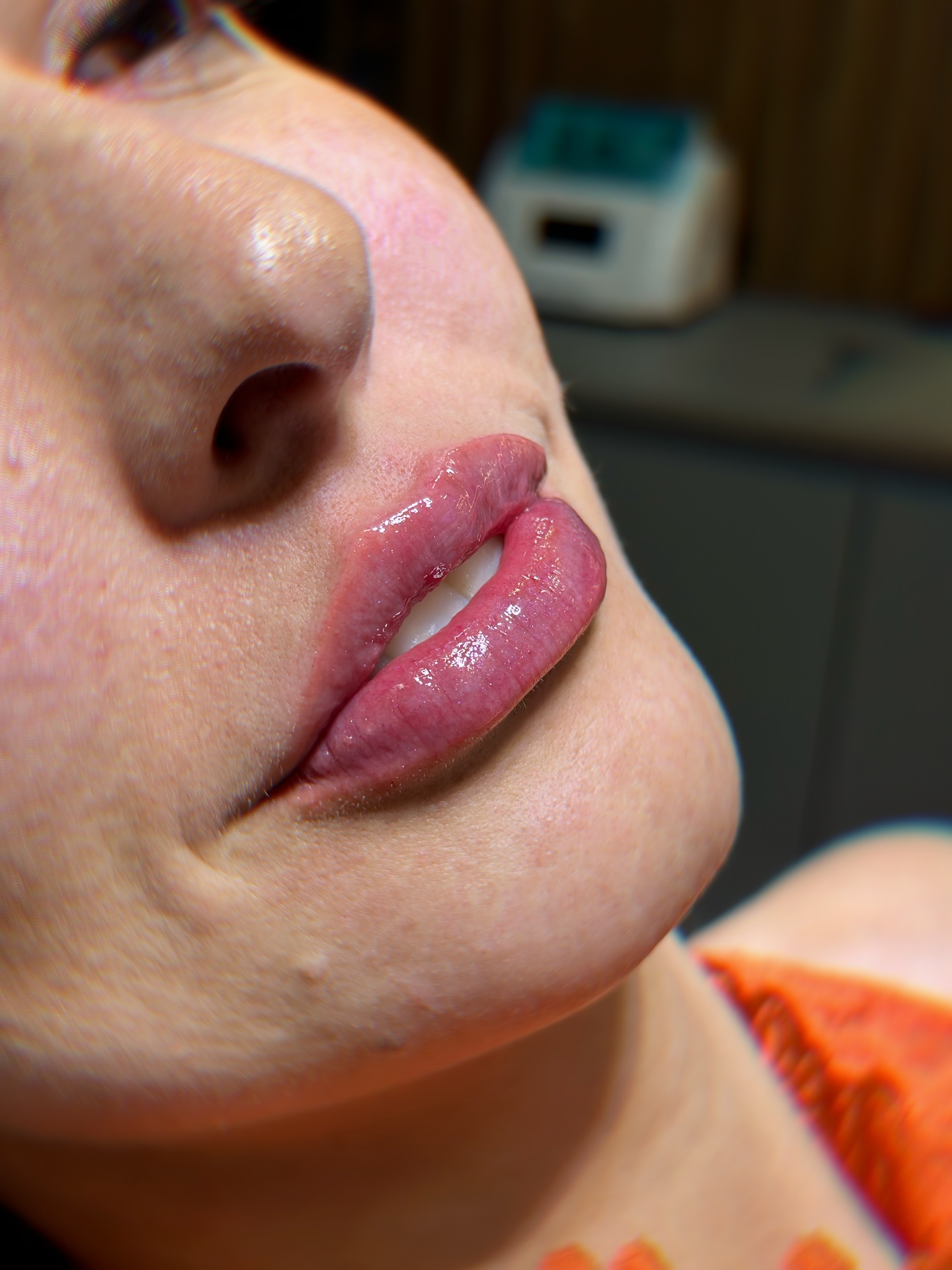 Depois - Preenchimento Labial