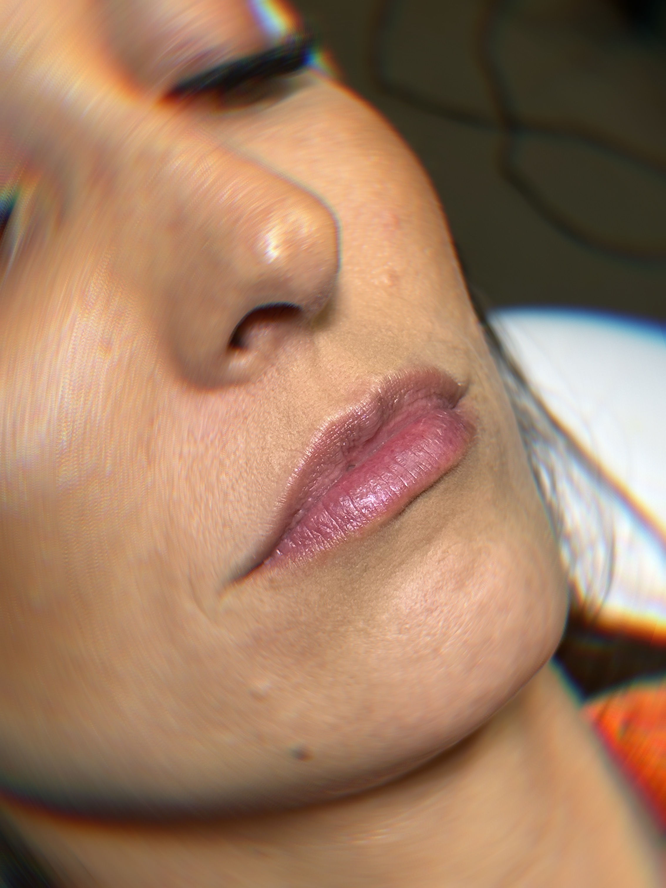 Antes - Preenchimento Labial