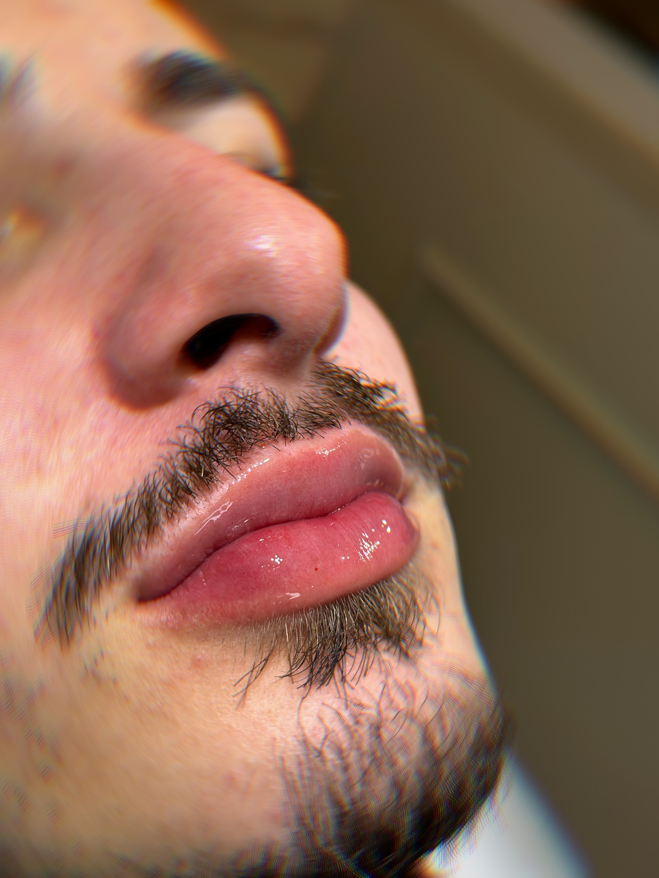 Depois - Rejuvenescimento Facial