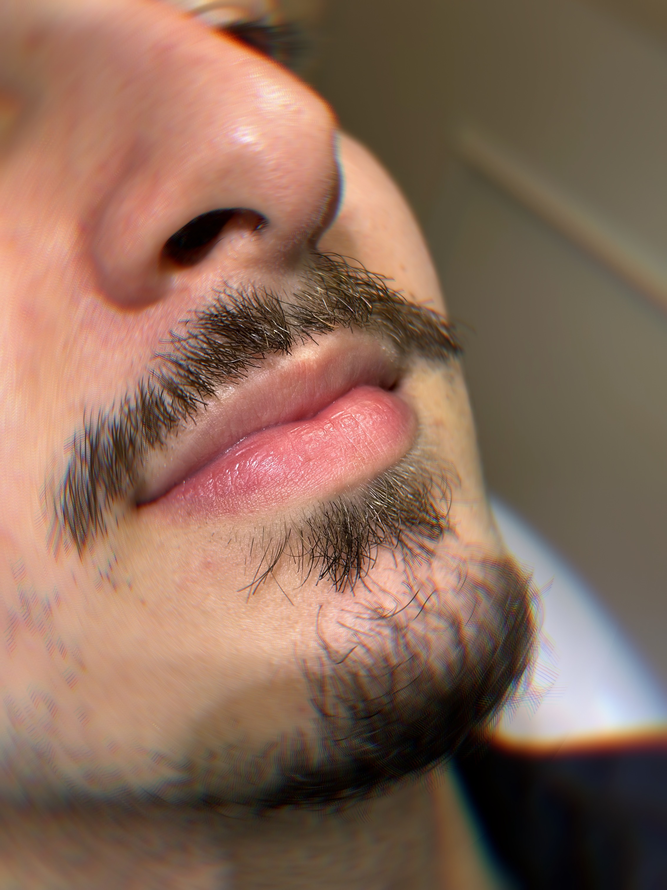 Antes - Rejuvenescimento Facial