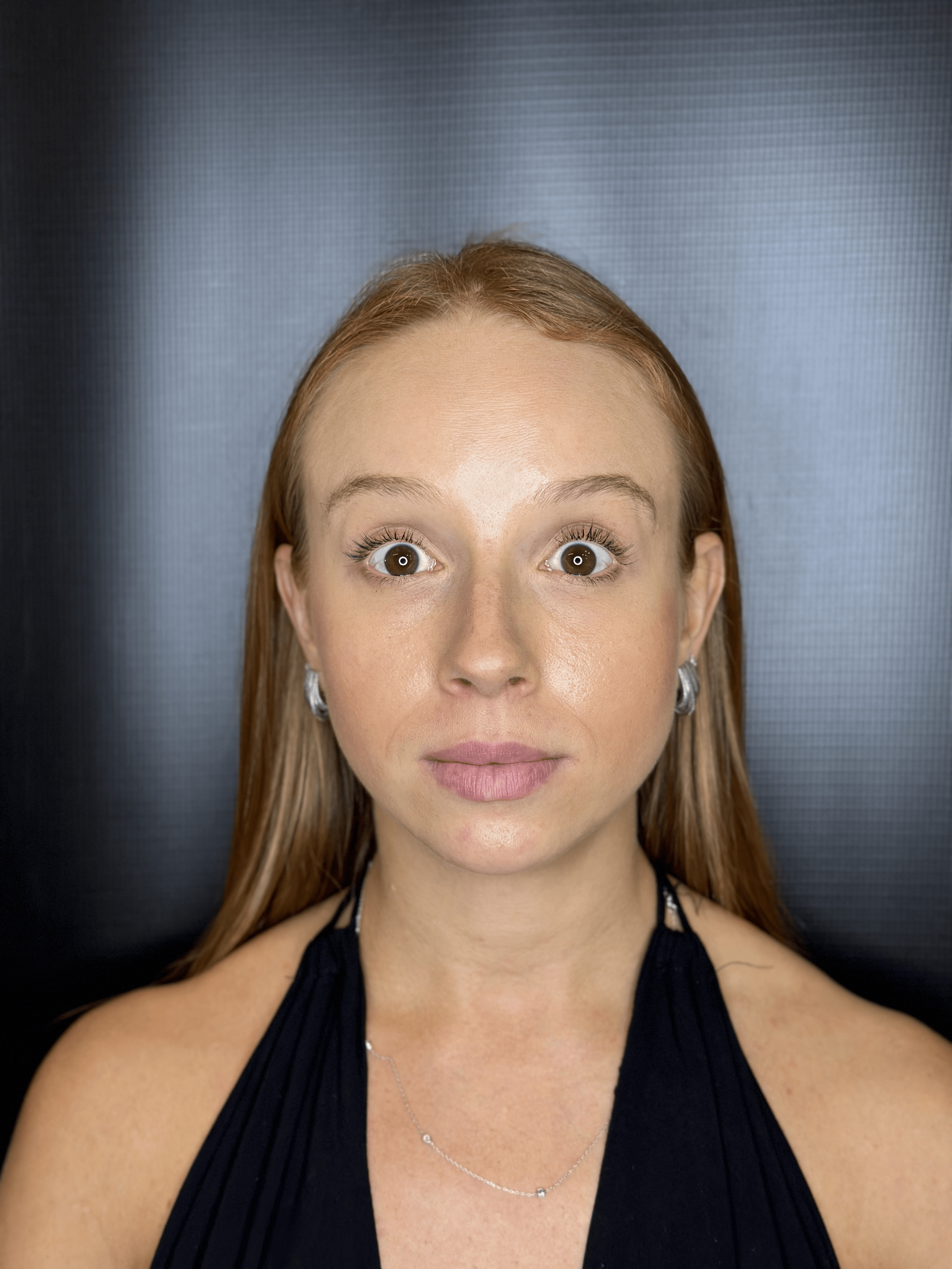 Depois - Harmonização Facial