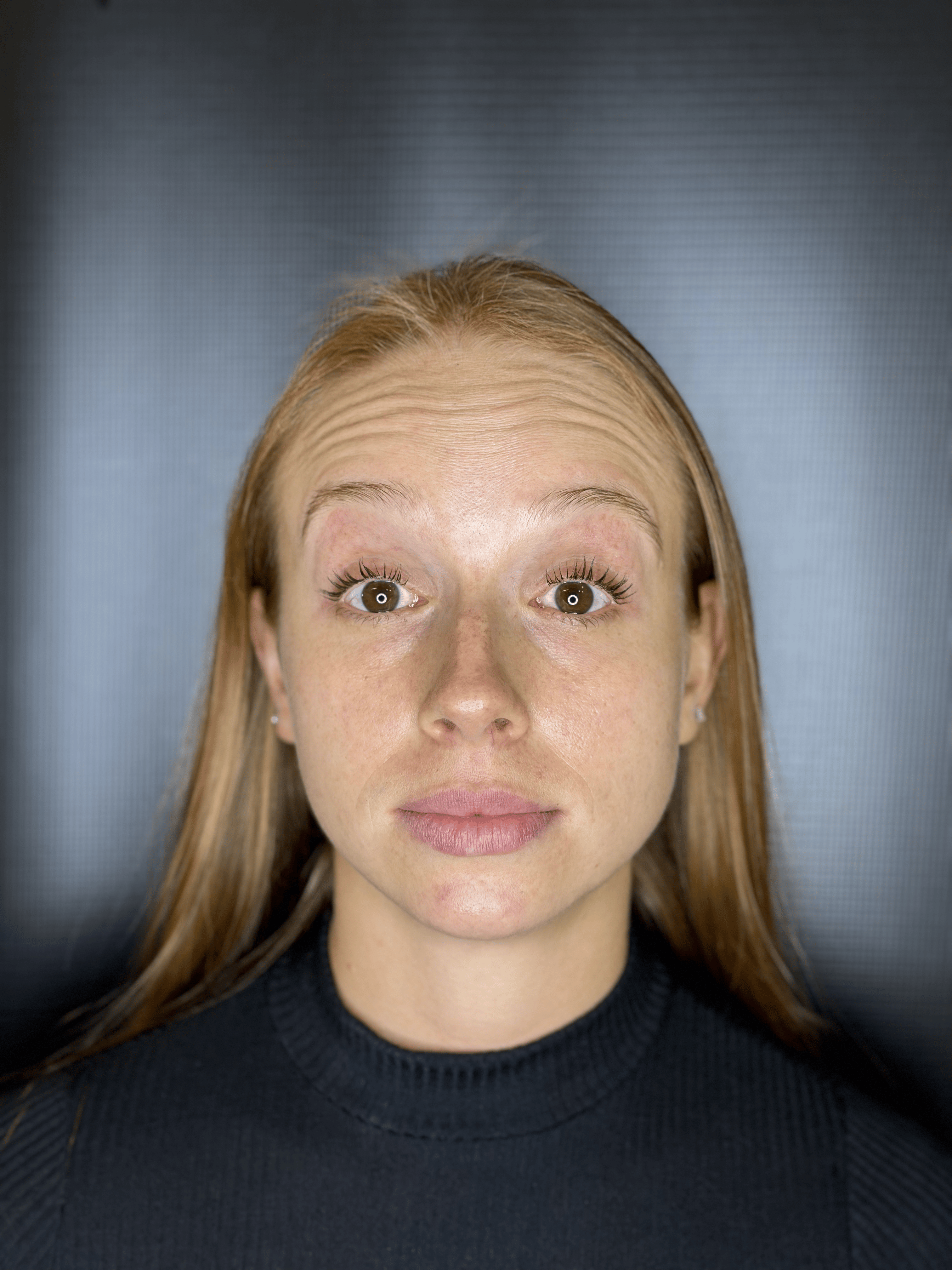 Antes - Harmonização Facial